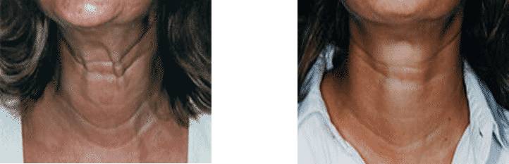 Cervical Cord Vorher Nachher Dermatologie Hanau