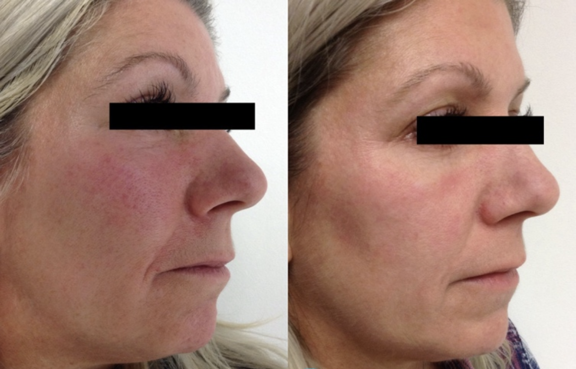 Couperose Behandlung Vorher Nachher Dermatologie Hanau