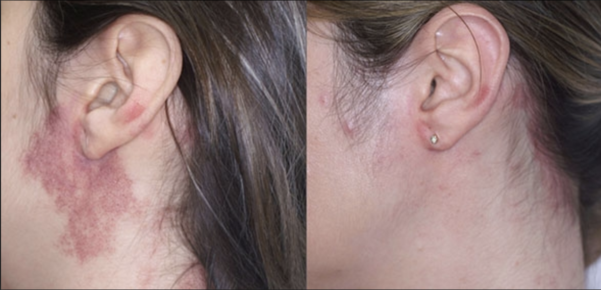 Feuermal Vorher Nachher3 Vorher Nachher Dermatologie Hanau