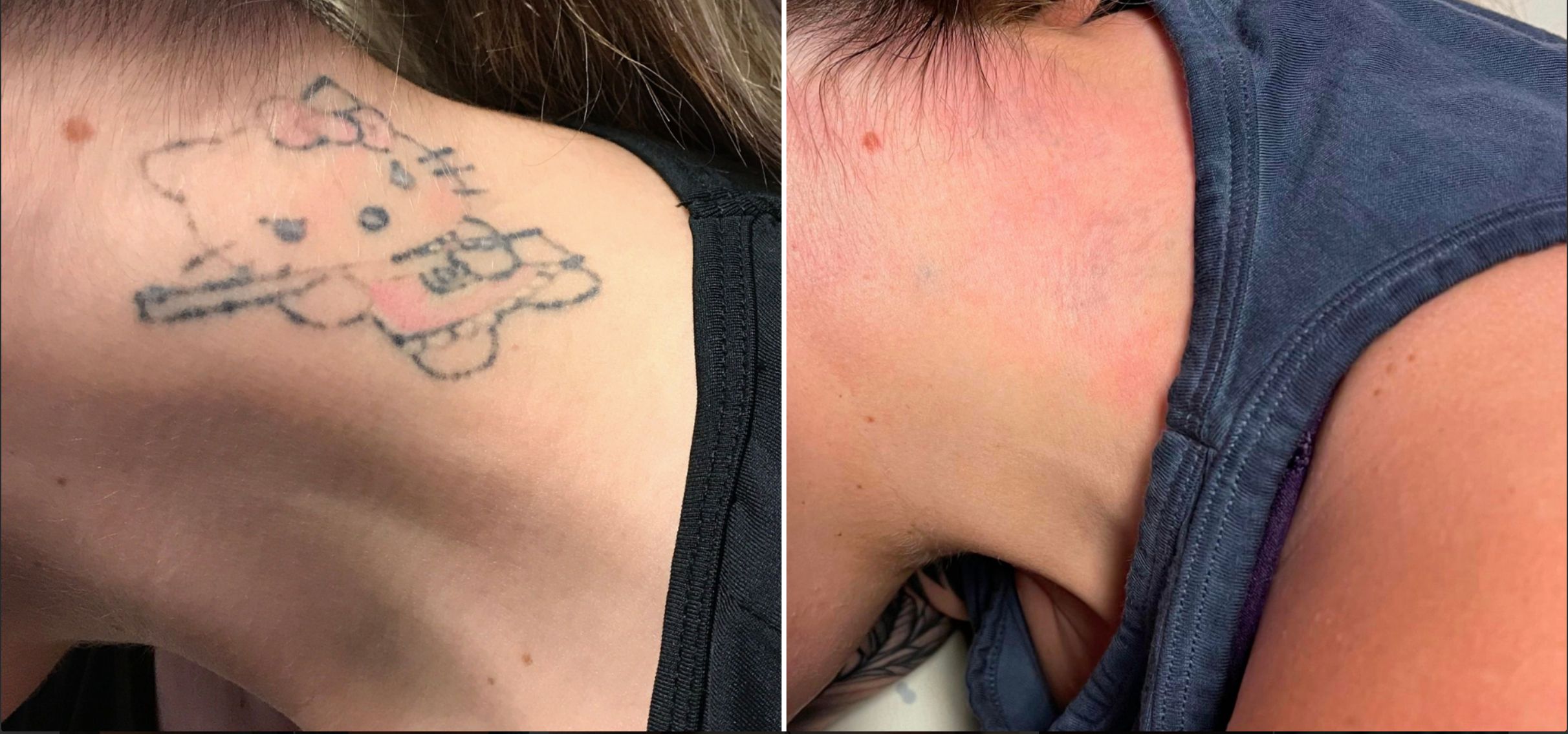 Tattooentfernung Verlauf 1