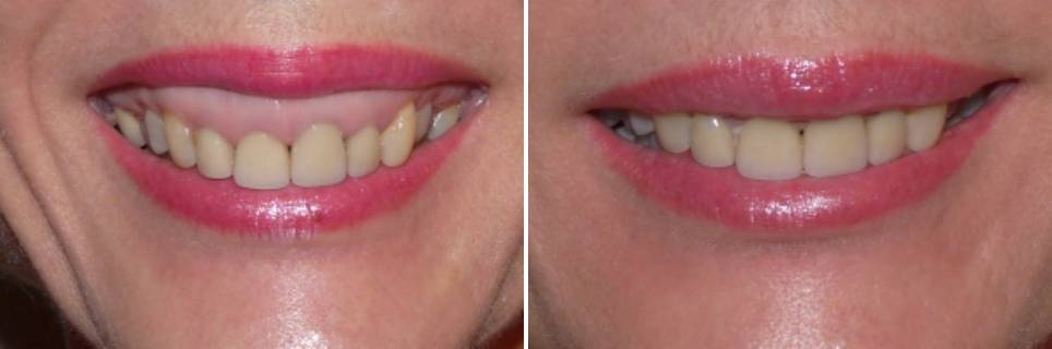 Gummy Smile Vorher Nachher Dermatologie Hanau