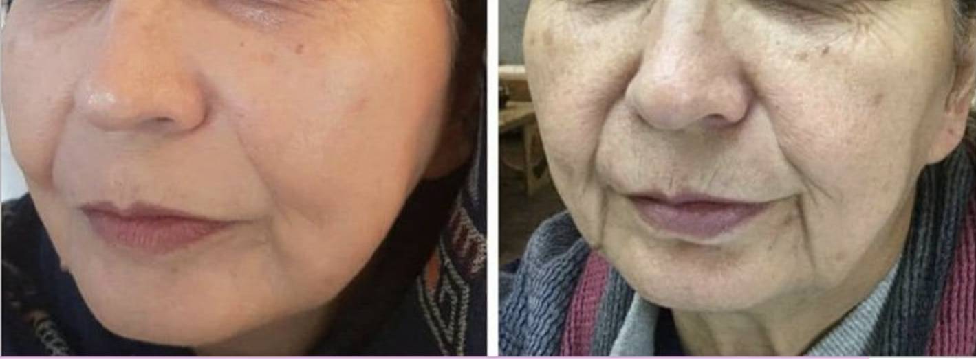 Haengebaeckchen Behandlung Vorher Nachher Dermatologie Hanau