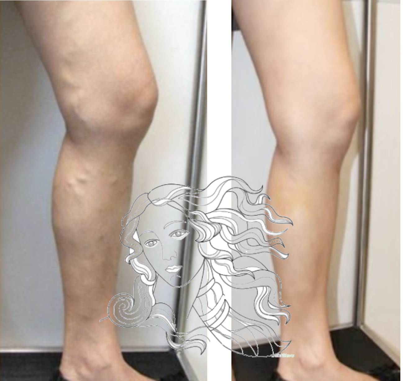 Krampfadern Laser Behandlung Vorher Nachher Dermatologie Hanau