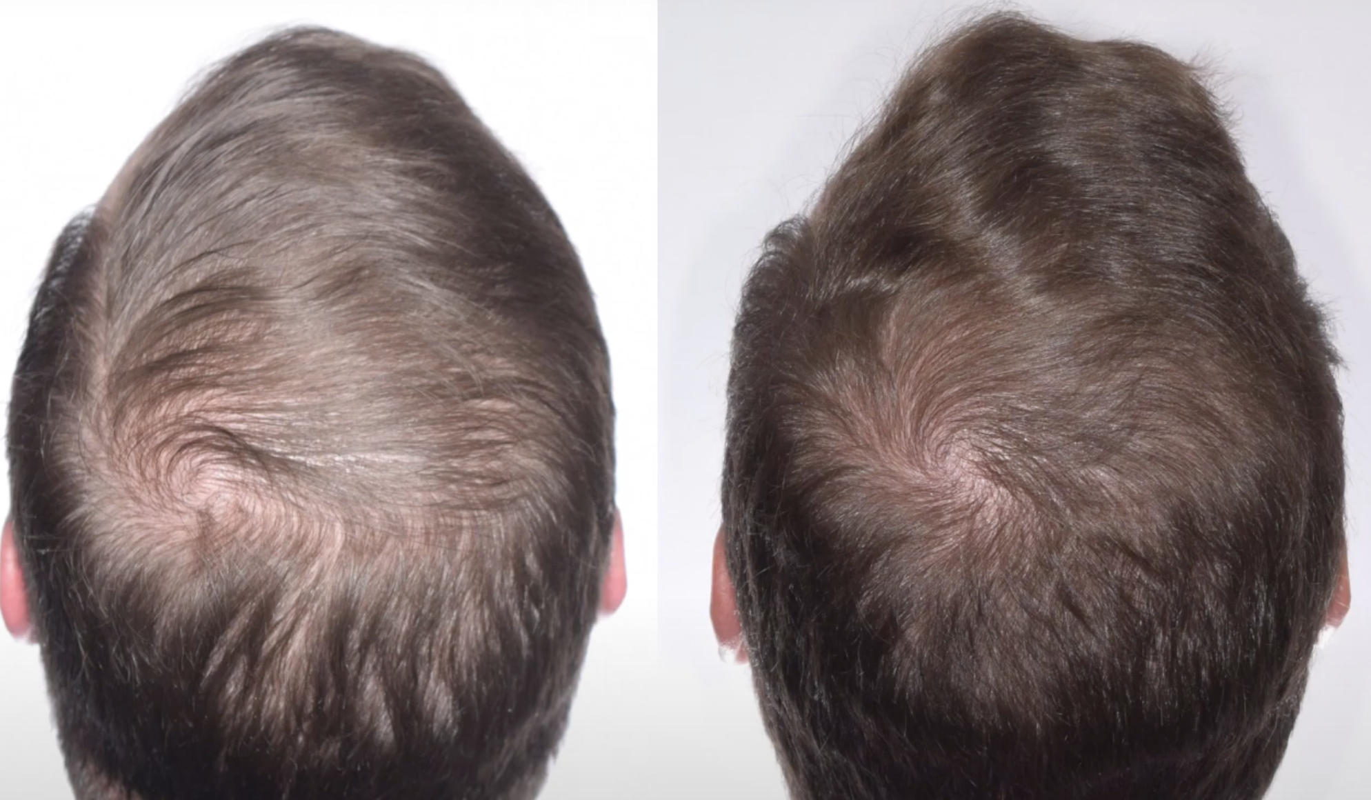 Low Level Laser Therapie Fuer Haarwachstum Vorher Nachher Dermatologie Hanau