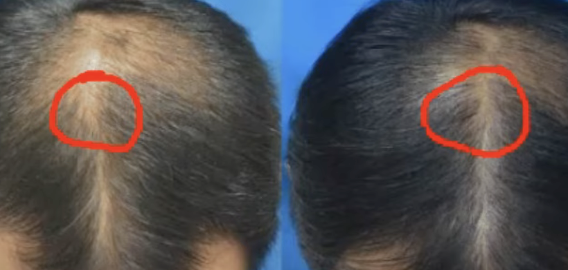 Low-Level-Lasertherapie Haare