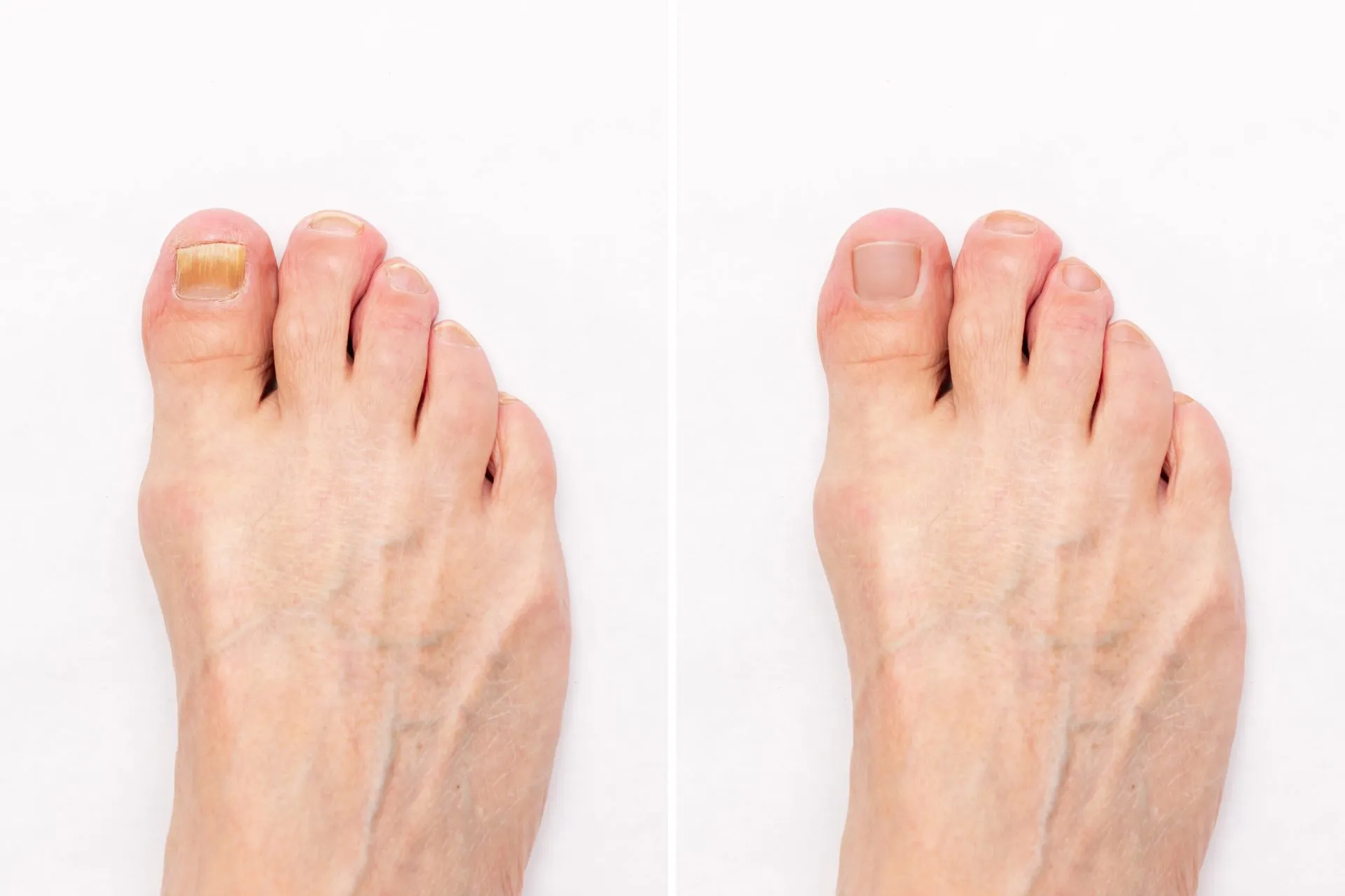 Nagelpilz Ausgangsbefund Nagelpilz Ausgangsbefund