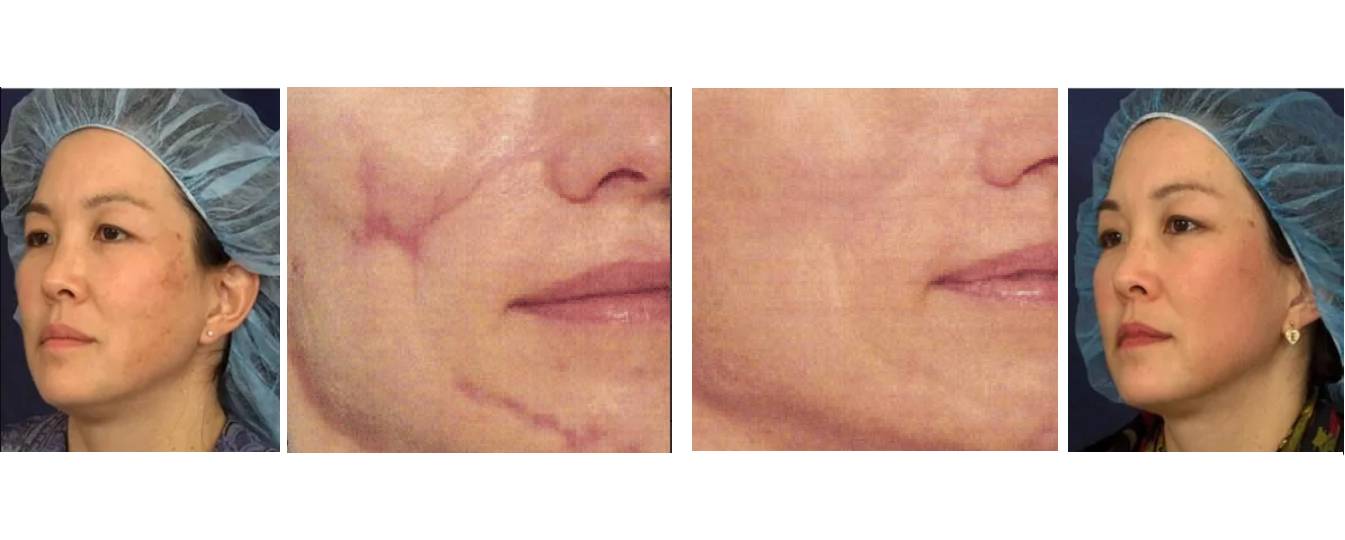Narben Korrekture Vorher Nachher Dermatologie Hanau
