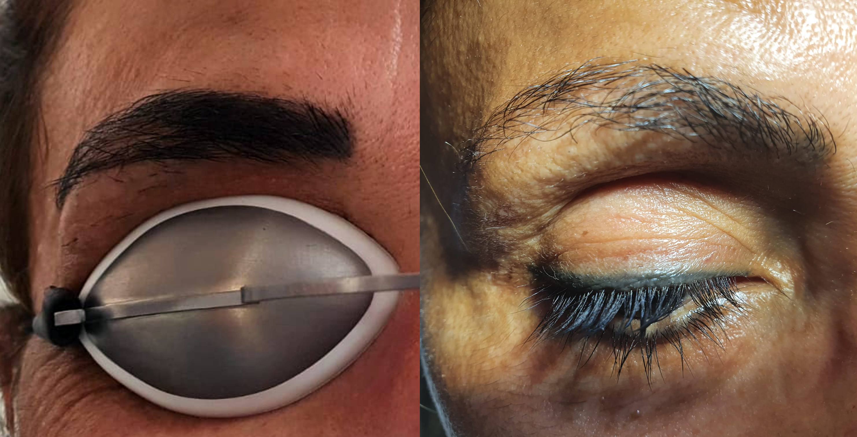 Permanent Make Up Entfernen Vorher Nachher Dermatologie Hanau
