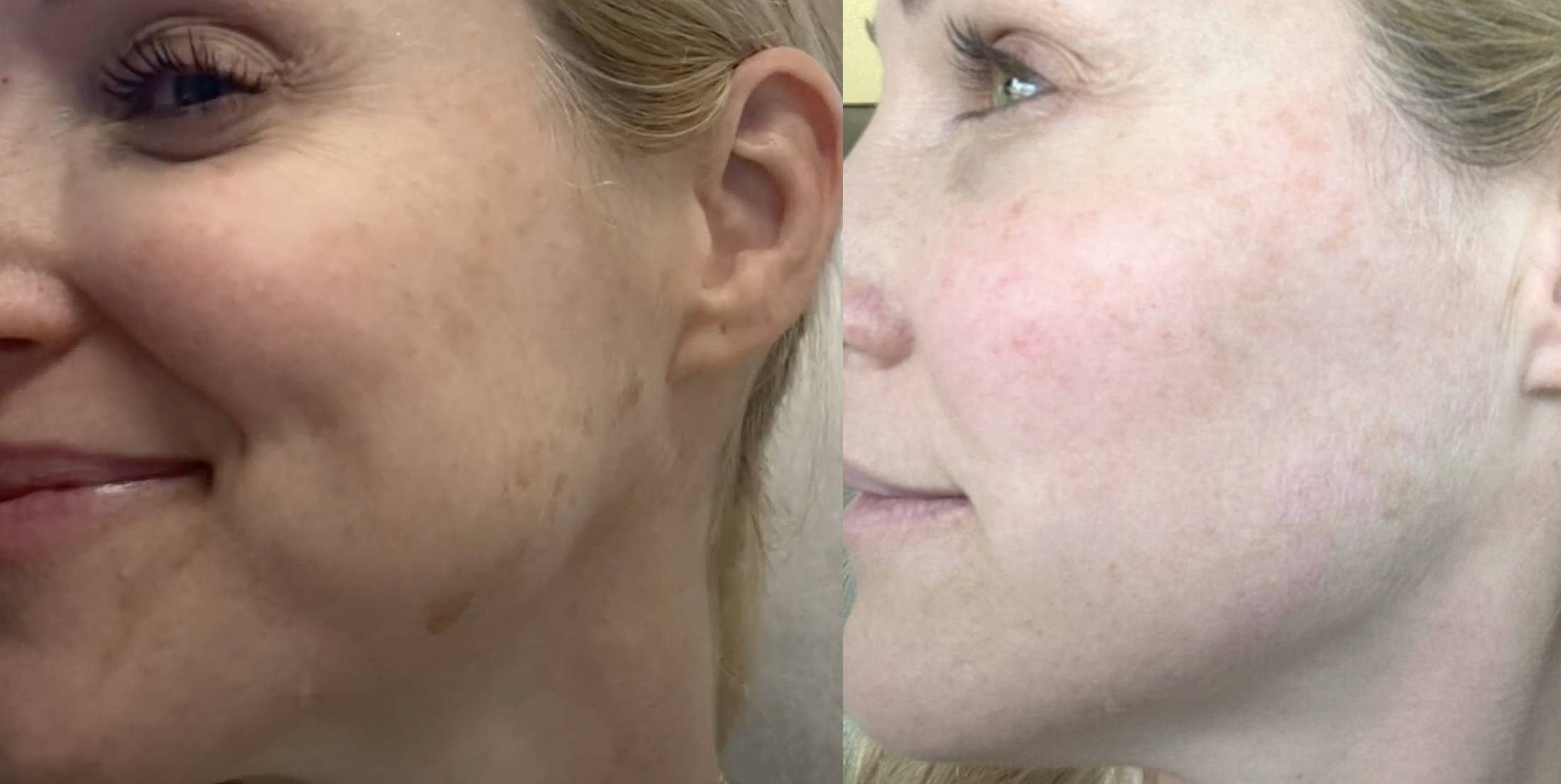 Pico-Laser Hautverjüngung Pico-Laser Hautverjüngung
