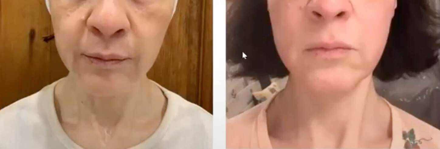 Pro Vorher Nacher3 Vorher Nachher Dermatologie Hanau