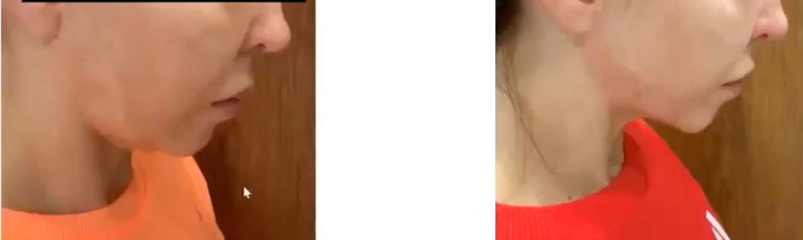 Pro Vorher Nacher6 Vorher Nachher Dermatologie Hanau