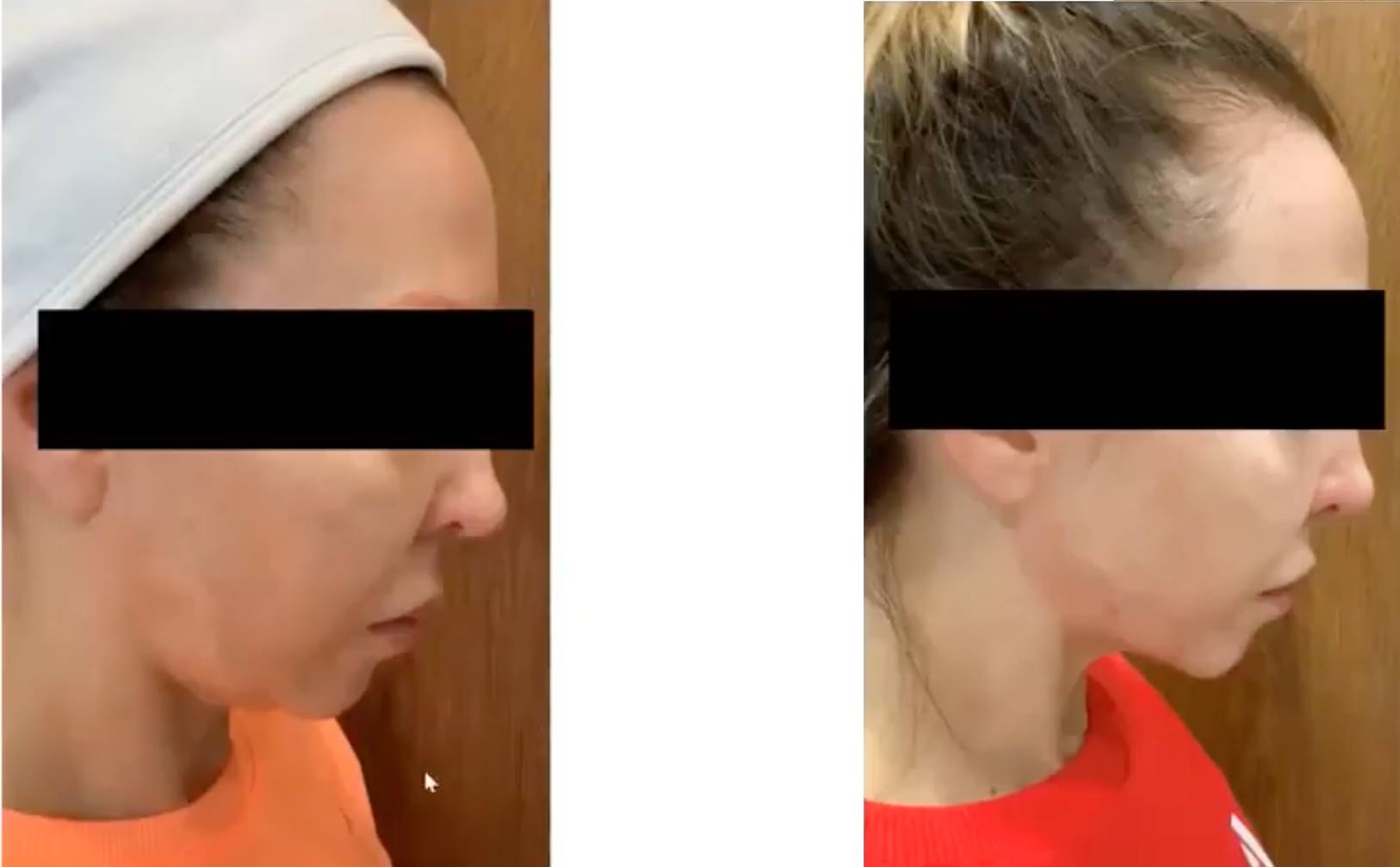 Pro Vorher Nacher6 Vorher Nachher Dermatologie Hanau