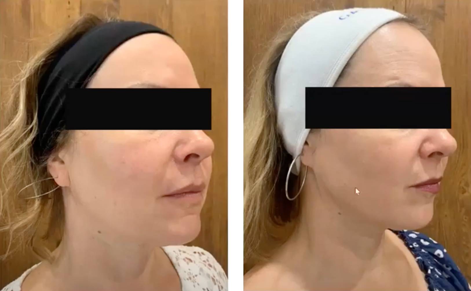 Profound Vorher Nacher5 Vorher Nachher Dermatologie Hanau