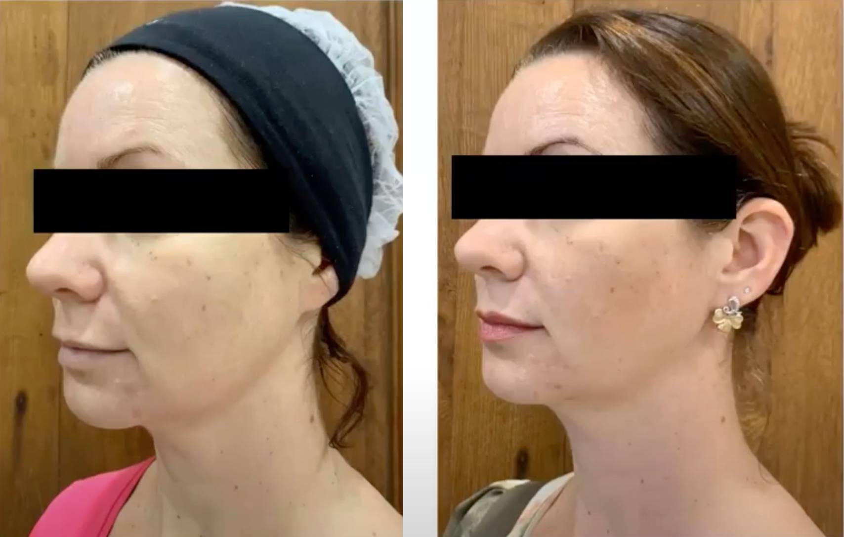 Profound Vorher Nacher6 Vorher Nachher Dermatologie Hanau