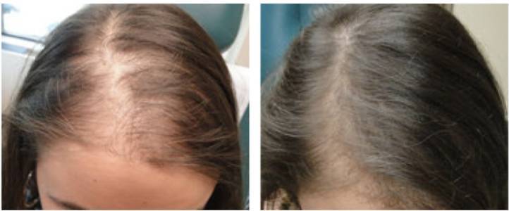 PRP Behandlung3 Vorher Nachher Dermatologie Hanau
