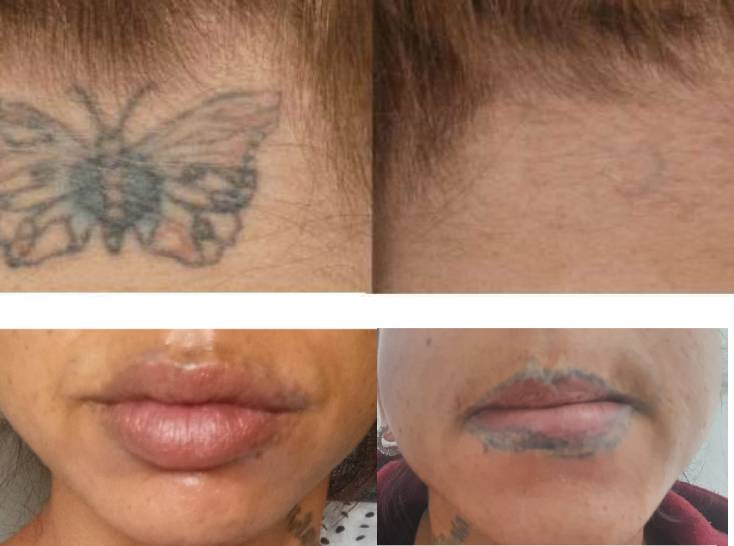 Tattoo Entfernung In Hanau Vorher Nachher Dermatologie Hanau