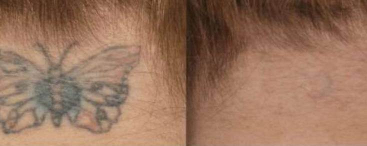 Tattooentfernung Verlauf 3