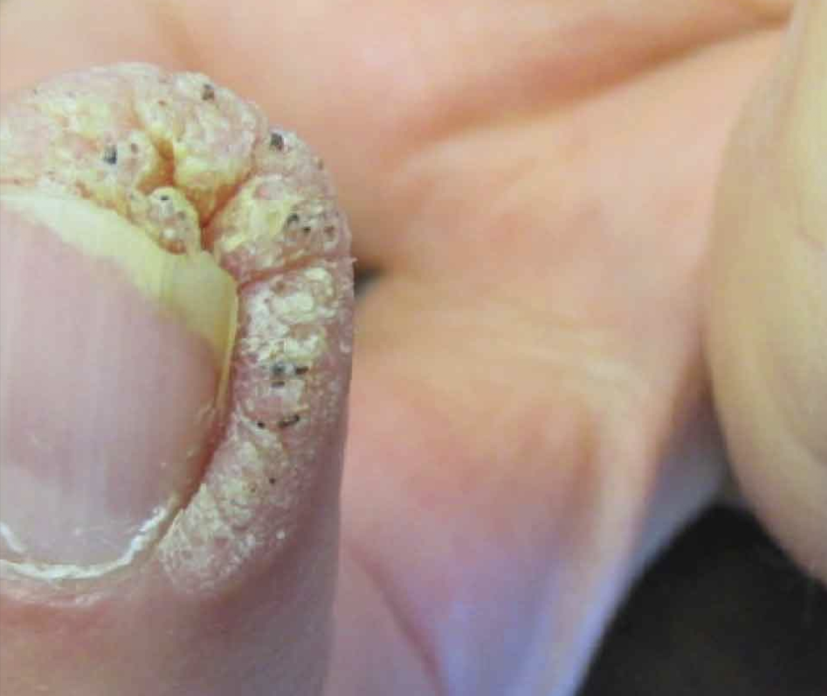 Warzen im Nagelbereich vor dermatologischer Behandlung in Hanau