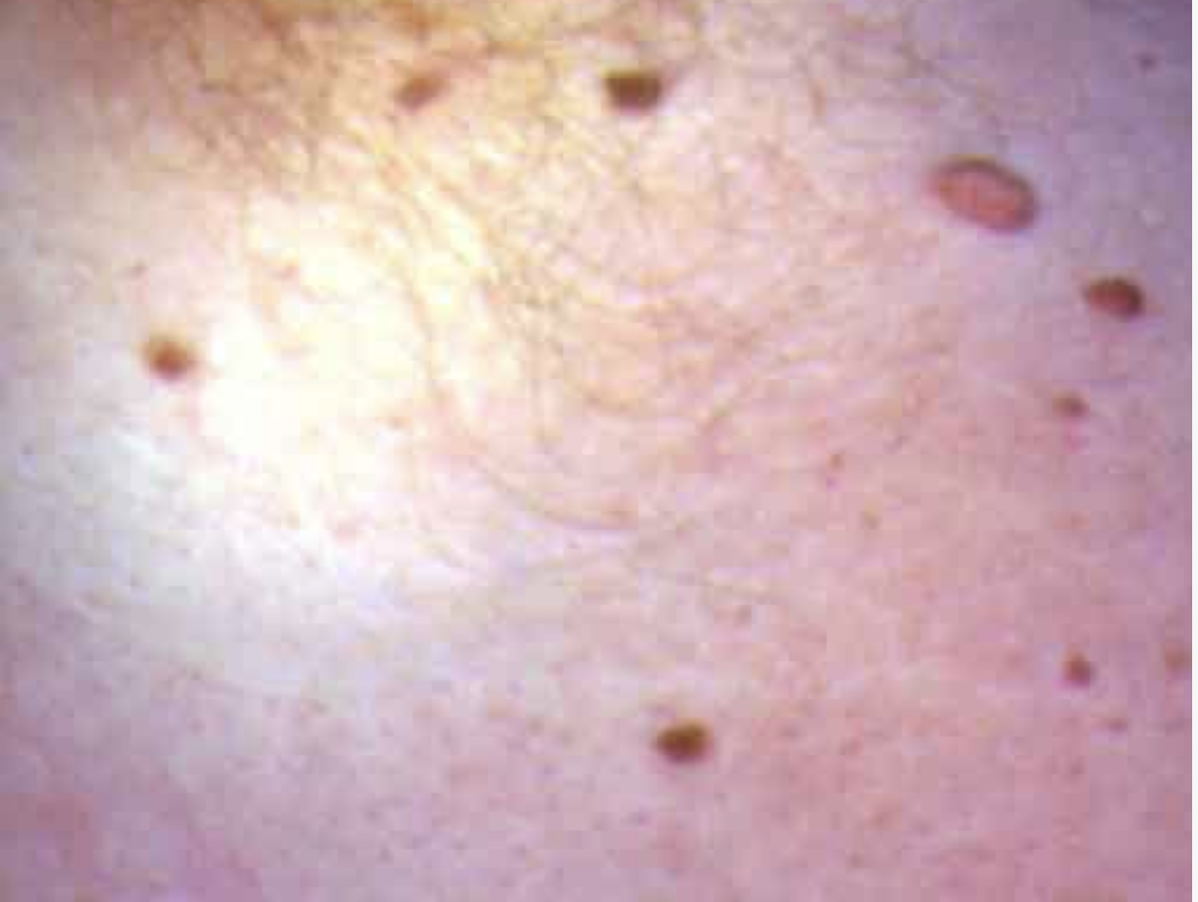 Gewöhnliche Warzen an der Haut vor dermatologischer Behandlung in Hanau