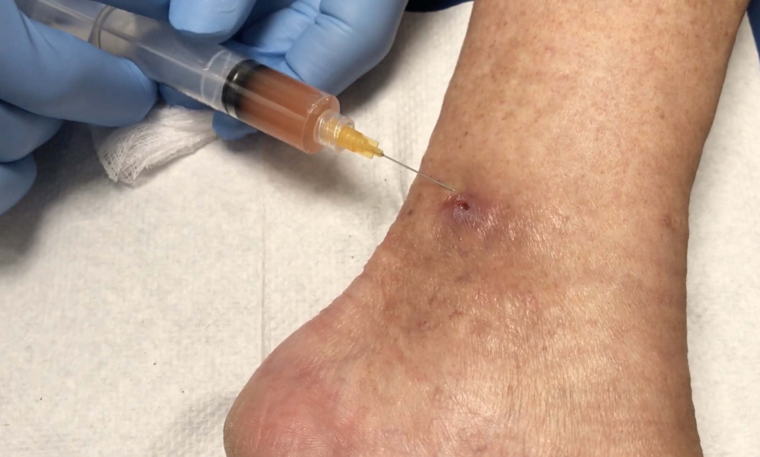 PRP Eigenbluttherapie als biotherapeutischer Ansatz bei chronischen Wunden