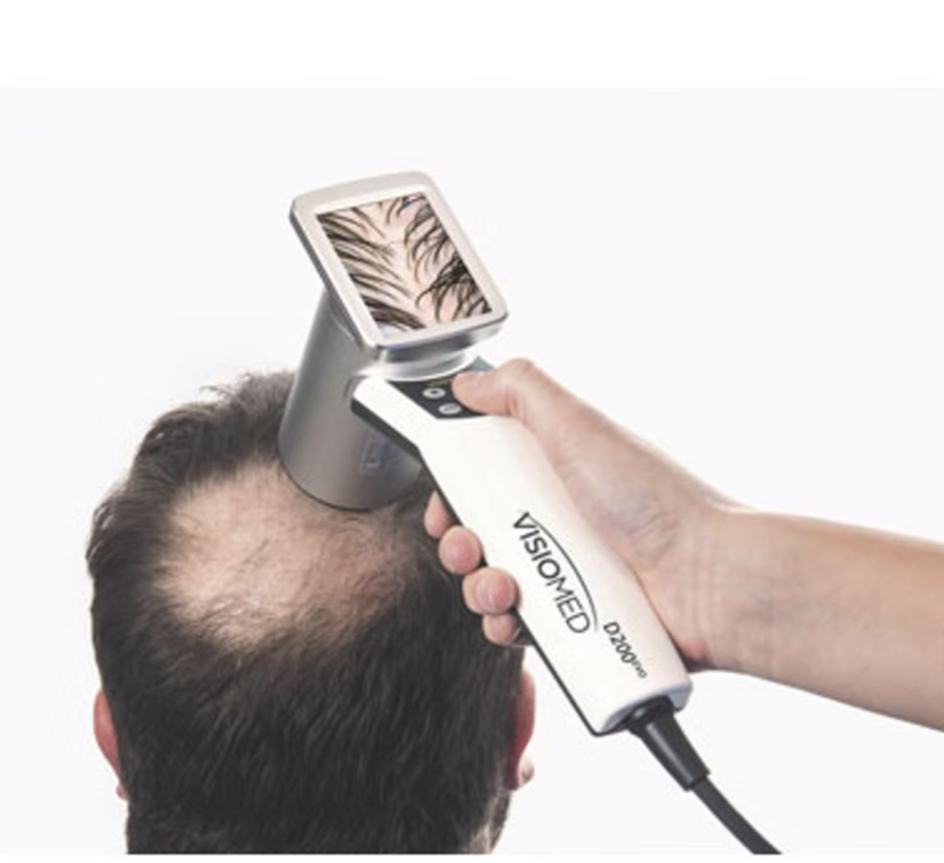 Low-Level-Lasertherapie (LLLT) für das Haarwachstum